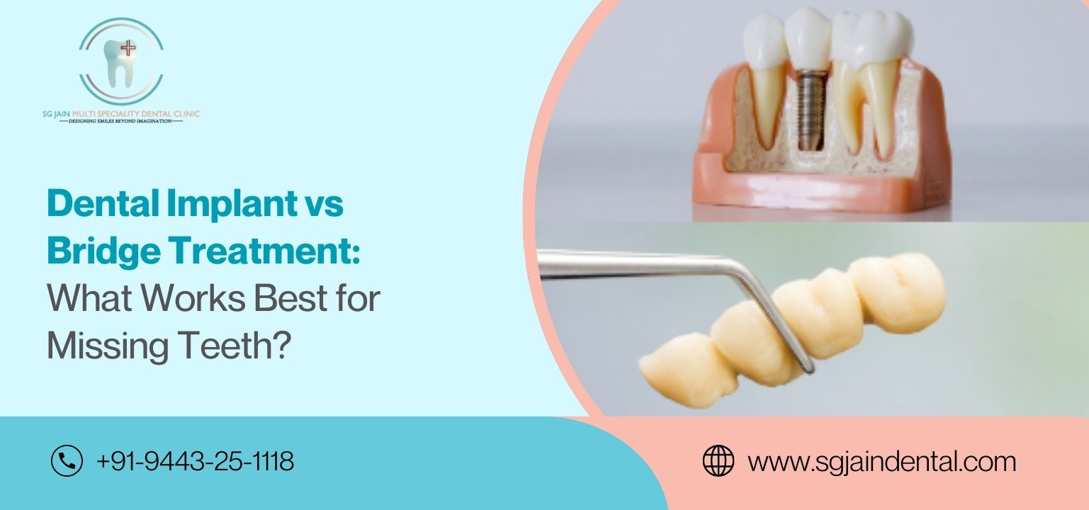 Dental Implant vs Bridge Treatment: What Works Best for Missing Teeth?