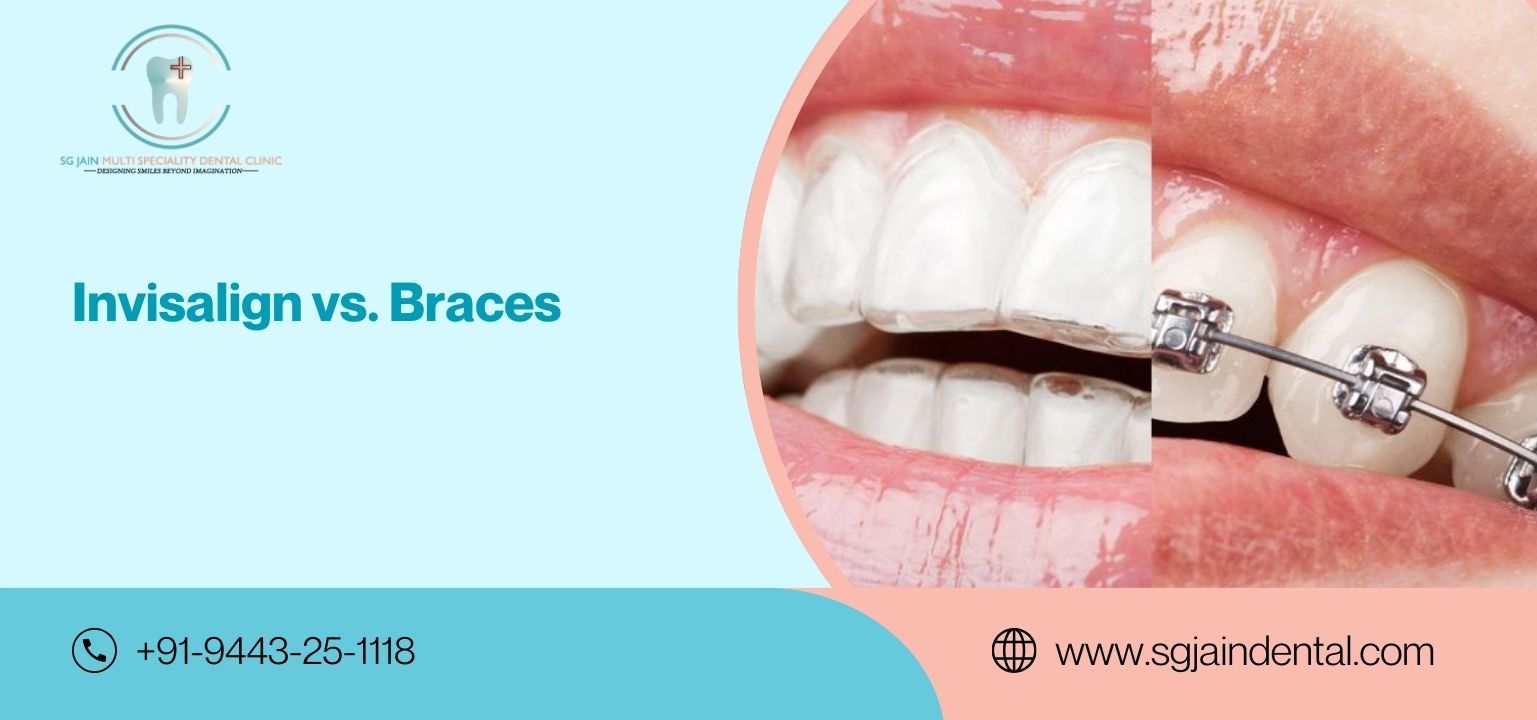 Invisalign vs. Braces: Which Is Better?