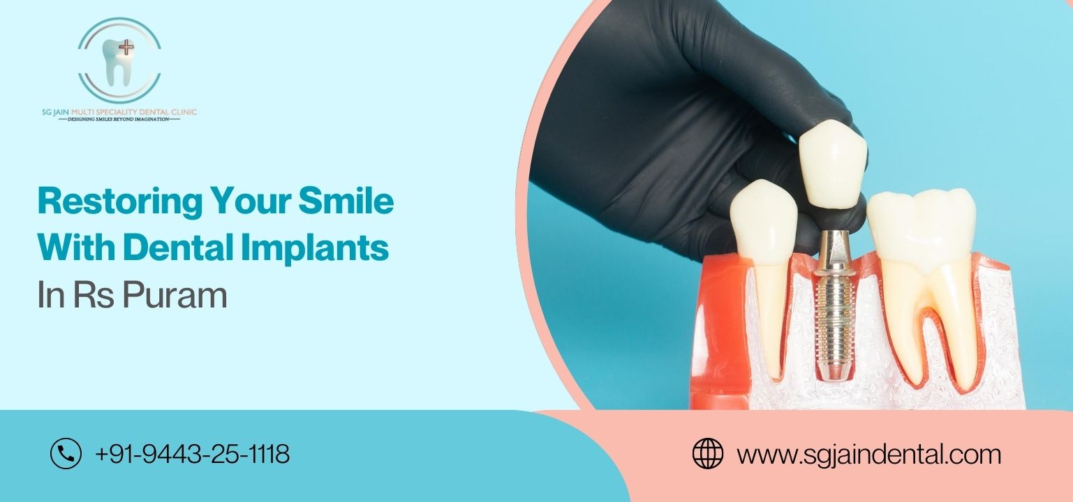 Restoring Your Smile with Dental Implants in R.S. Puram Coimbatore
