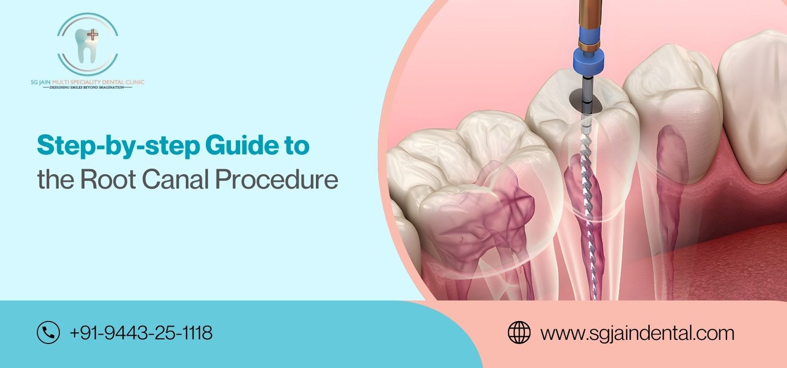 Step-By-Step Guide To The Root Canal Procedure