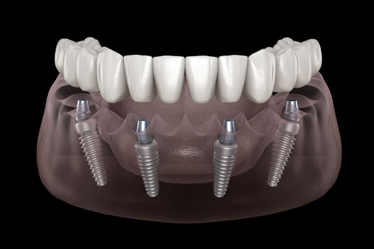 all on 4/6 implant