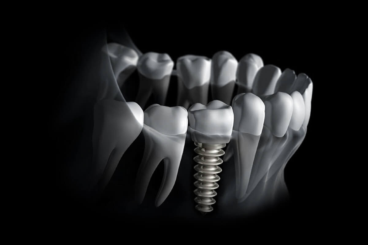 Dental-Implants