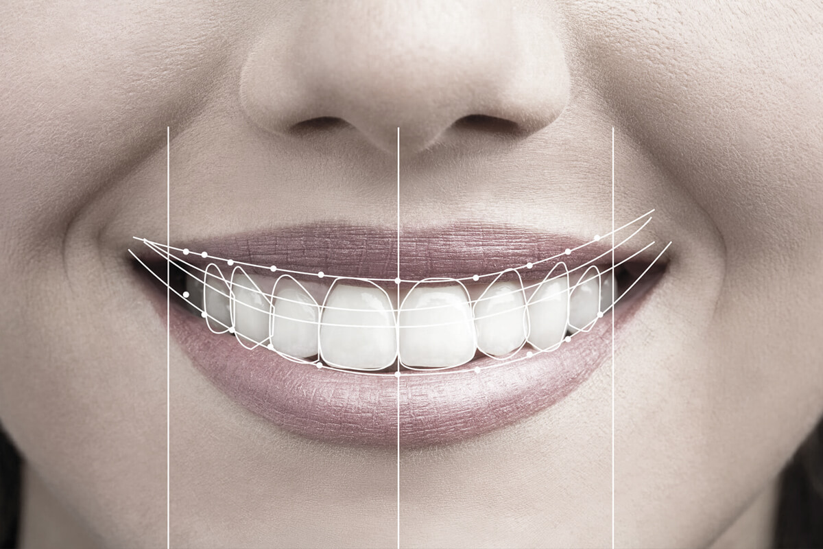 Digital-Smile-Designing