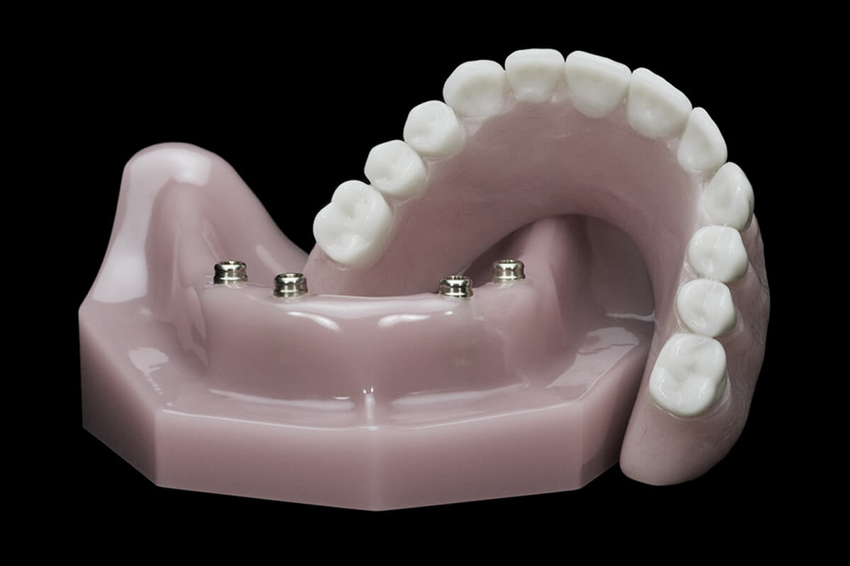 Over-Denture