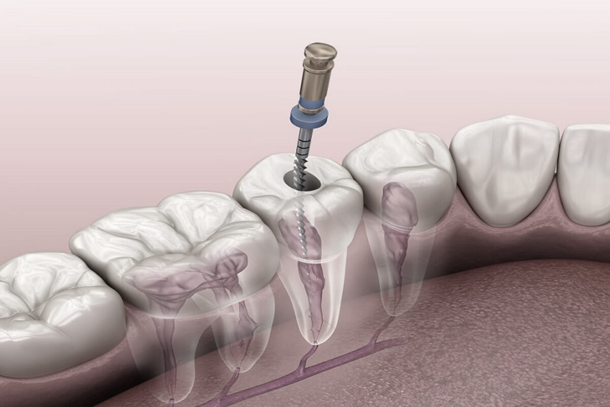 root canal treatment