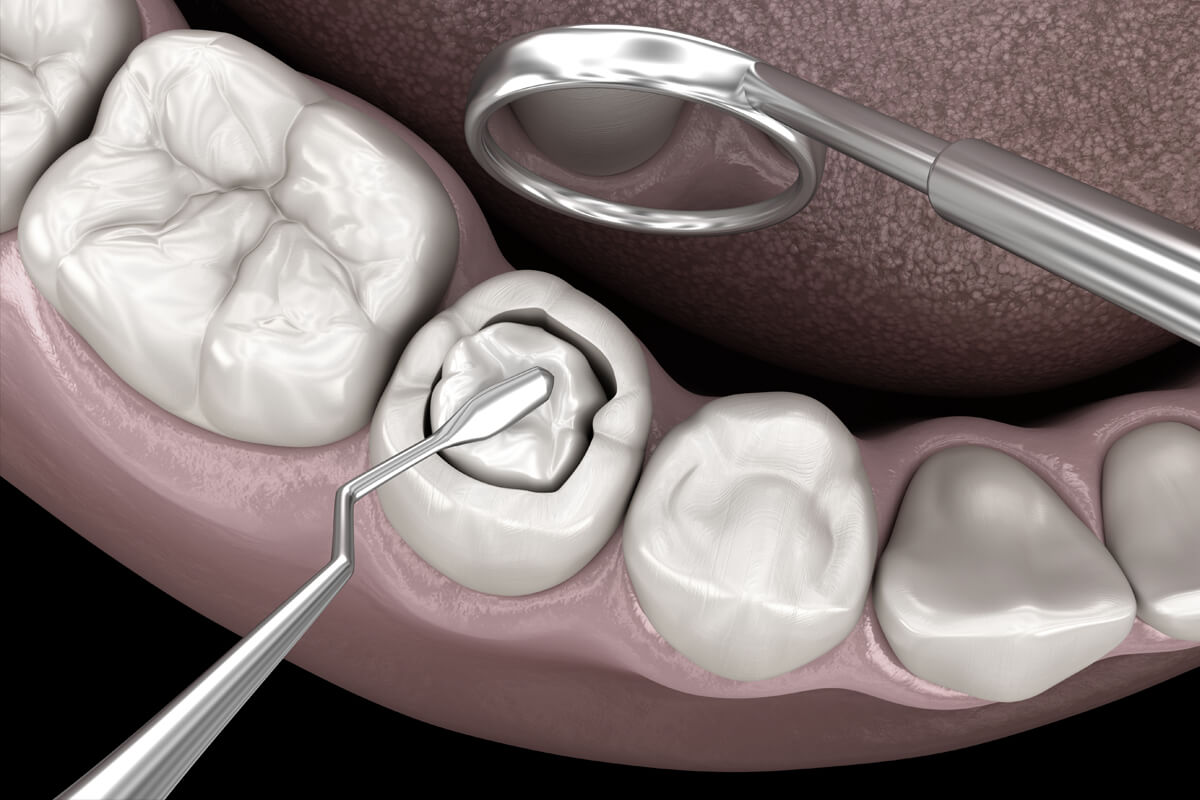 tooth colored filling