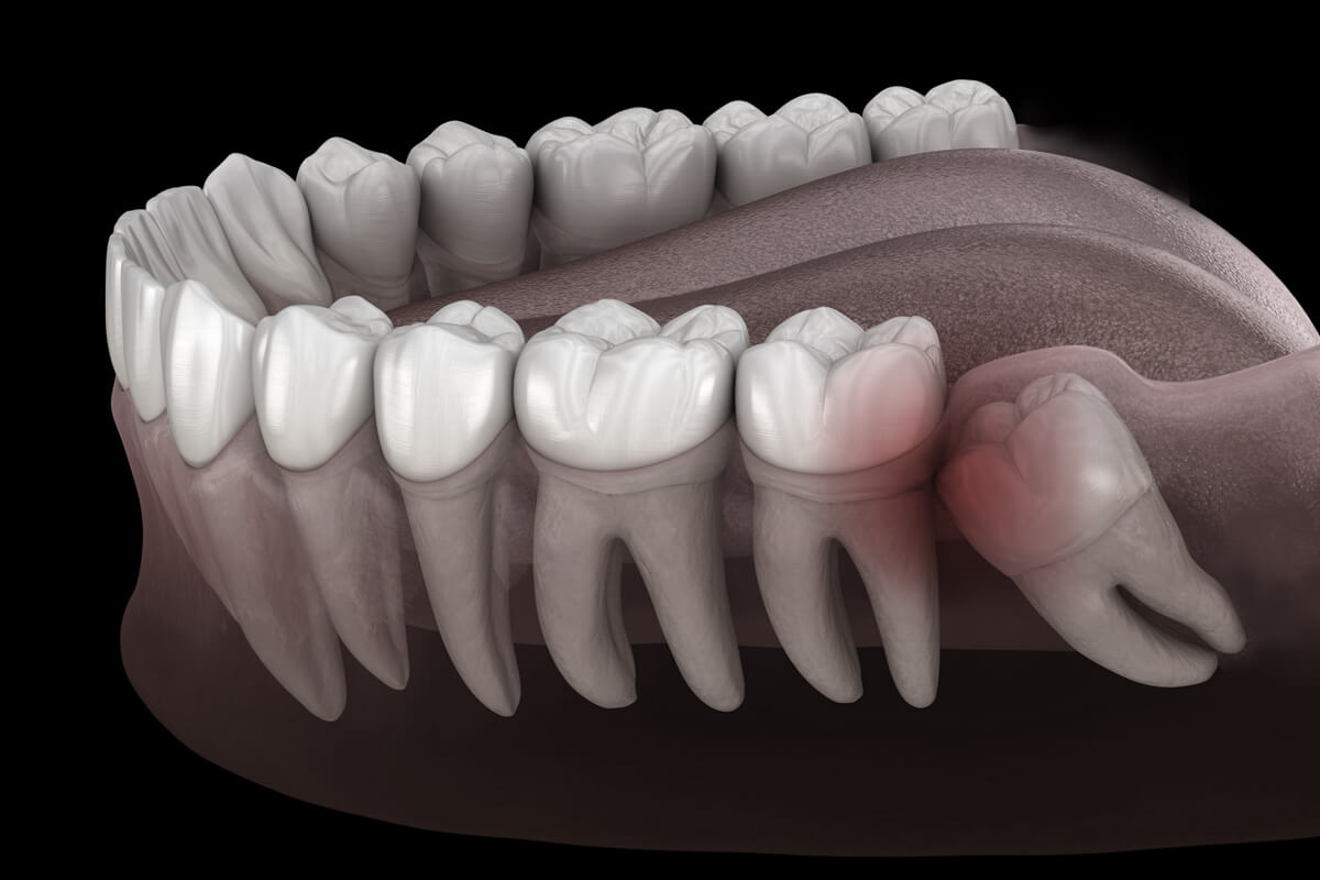 wisdom tooth removal